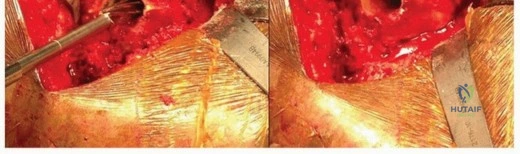 صورة طبية: سيقان مفصل الفخذ المسامية الموسعة: نجاح مثبت وتثبيت فائق لمفاصل ورك تدوم طويلاً في صنعاء مع الأستاذ الدكتور محمد هطيف