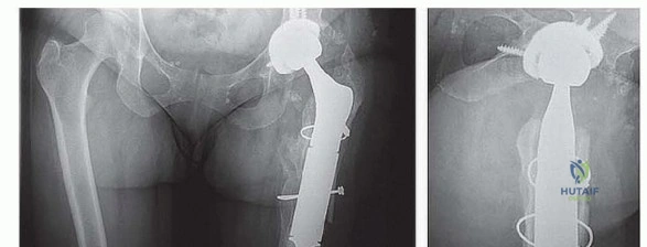صورة توضيحية لـ إنقاذ الأطراف: أحدث التطورات في استبدال الجزء العلوي من عظم الفخذ