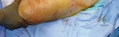 صورة توضيحية لـ النهج الخلفي لمفصل الورك: دليل شامل لاستعادة الحركة في صنعاء مع الأستاذ الدكتور محمد هطيف