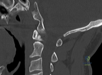 صورة توضيحية لـ حالات العمود الفقري: أهمية التشخيص الدقيق والعلاج الفعال مع الأستاذ الدكتور محمد هطيف في صنعاء