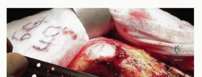 صورة طبية: استبدال مفصل الورك الكلي بالإسمنت الطبي: حل ناجح وموثوق لاستعادة الحركة