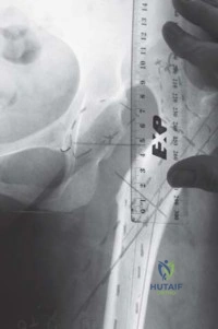 صورة طبية: استبدال مفصل الورك الكلي الناجح في خلل التنسج النمائي للورك: دليل شامل من الأستاذ الدكتور محمد هطيف