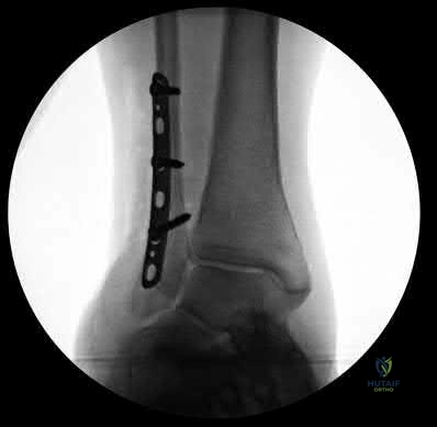 صورة طبية: دليل شامل لكسور وإصابات الجهاز الحركي: رعاية متقدمة في صنعاء مع الأستاذ الدكتور محمد هطيف