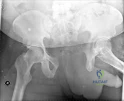 صورة طبية: دليل شامل لكسور وإصابات الجهاز الحركي: رعاية متقدمة في صنعاء مع الأستاذ الدكتور محمد هطيف