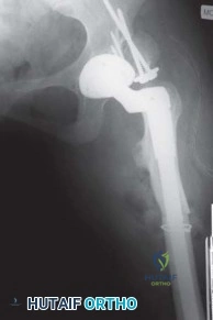 صورة طبية: استبدال مفصل الورك الكلي الناجح في خلل التنسج النمائي للورك: دليل شامل من الأستاذ الدكتور محمد هطيف