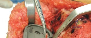 صورة توضيحية لـ جراحة استبدال المفاصل بدون أسمنت: دليل شامل للمرضى مع الأستاذ الدكتور محمد هطيف في صنعاء