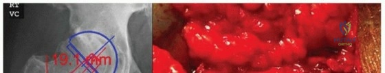 صورة طبية: سيقان مفصل الفخذ المسامية الموسعة: نجاح مثبت وتثبيت فائق لمفاصل ورك تدوم طويلاً في صنعاء مع الأستاذ الدكتور محمد هطيف