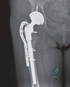 صورة طبية: استبدال مفصل الورك لإنقاذ حالات فشل تثبيت كسور الورك: حل فعال لاستعادة الحركة