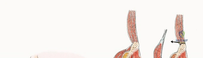 استخدام الدعامات الحقية لإعادة البناء