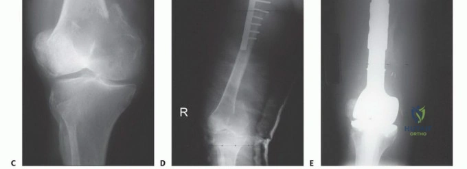 صورة لأشعة رنين مغناطيسي (MRI) تُظهر نقائل في العمود الفقري