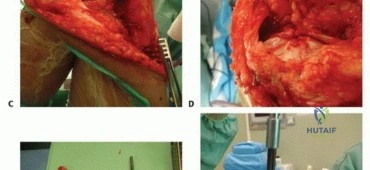 صورة توضيحية لـ الأطراف الصناعية القابلة للتمدد للأطفال: دليل شامل للمرضى حول الوقاية من العدوى والعلاج في صنعاء مع الأستاذ الدكتور محمد هطيف