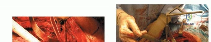 صورة طبية: جراحة إعادة زرع مفصل الورك الحل النهائي للمفاصل الصناعية الملتهبة في صنعاء مع الأستاذ الدكتور محمد هطيف