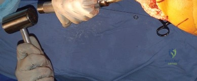 المفاصل الصناعية المقيدة وشبه المقيدة