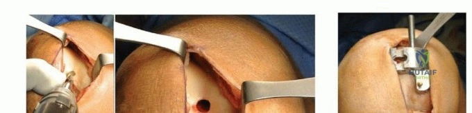 تشريح مفصل الركبة يوضح الحجرات الثلاث