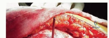 صورة توضيحية لـ استبدال مفصل الورك الكلي بالإسمنت الطبي: حل ناجح وموثوق لاستعادة الحركة