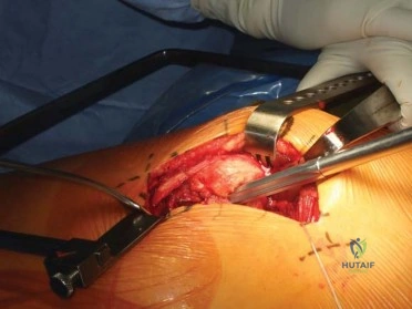 صورة طبية: استبدال مفصل الورك الكلي الناجح في خلل التنسج النمائي للورك: دليل شامل من الأستاذ الدكتور محمد هطيف