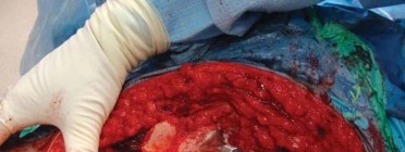 صورة طبية: استبدال مفصل الورك الكلي الناجح في خلل التنسج النمائي للورك: دليل شامل من الأستاذ الدكتور محمد هطيف