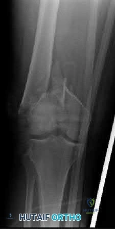 صورة طبية: دليل شامل لكسور وإصابات الجهاز الحركي: رعاية متقدمة في صنعاء مع الأستاذ الدكتور محمد هطيف