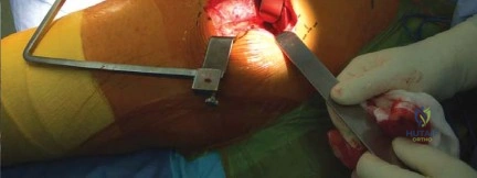 صورة طبية: استبدال مفصل الورك الكلي الناجح في خلل التنسج النمائي للورك: دليل شامل من الأستاذ الدكتور محمد هطيف
