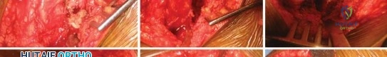 صورة طبية: استبدال مفصل الورك الكلي لالتهاب المفاصل الروماتويدي اليفعي: استعادة الحركة والأمل مع الأستاذ الدكتور محمد هطيف في صنعاء