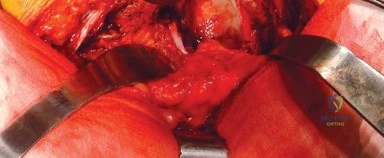 صورة طبية: المدخل الخلفي الجانبي لجراحة استبدال مفصل الورك الكلي: دليل شامل للمرضى في صنعاء مع الأستاذ الدكتور محمد هطيف