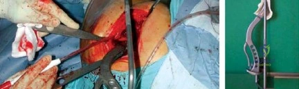 فحص الأشعة السينية الدقيق قبل الجراحة