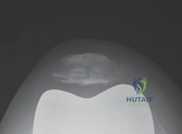 صورة طبية: إتقان موازنة الفجوة في مراجعة استبدال مفصل الركبة: تجنب الأخطاء الشائعة واستعادة الحركة مع الأستاذ الدكتور محمد هطيف