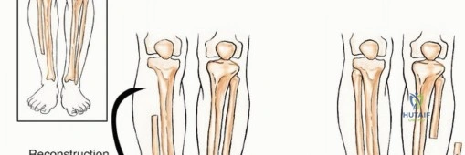 صورة توضيحية للعلاج الطبيعي