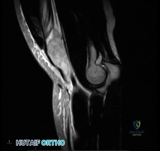 صورة طبية: آلام المرفق المعقدة: فهم وعلاج وتر الكاربوس الزندي القصير وغيرها من إصابات المرفق مع الأستاذ الدكتور محمد هطيف