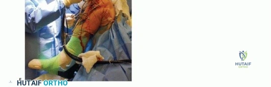 صورة طبية: استبدال مفصل الركبة الجزئي: حل متقدم لآلام الركبة المستمرة مع الأستاذ الدكتور محمد هطيف