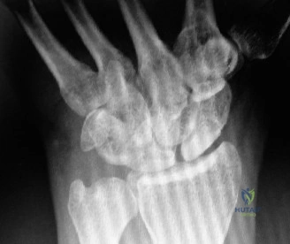 صورة طبية: علاج كسور الرسغ المعقدة: دليلك الشامل مع الأستاذ الدكتور محمد هطيف في صنعاء
