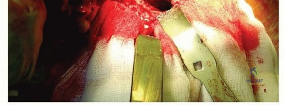 صورة توضيحية لـ وحدة إكستر للورك: إتقان تطعيم العظام بالضغط لمعالجة فقدان عظم الفخذ في صنعاء مع الأستاذ الدكتور محمد هطيف