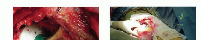 صورة طبية: استبدال مفصل الورك الكلي بالإسمنت الطبي: حل ناجح وموثوق لاستعادة الحركة