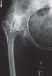 صورة طبية: استبدال مفصل الورك الكلي الناجح في خلل التنسج النمائي للورك: دليل شامل من الأستاذ الدكتور محمد هطيف
