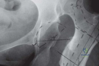 صورة طبية: استبدال مفصل الورك الكلي الناجح في خلل التنسج النمائي للورك: دليل شامل من الأستاذ الدكتور محمد هطيف