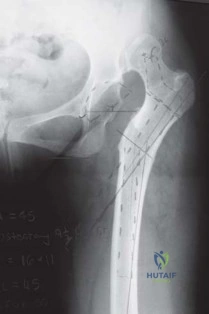 صورة طبية: استبدال مفصل الورك الكلي الناجح في خلل التنسج النمائي للورك: دليل شامل من الأستاذ الدكتور محمد هطيف