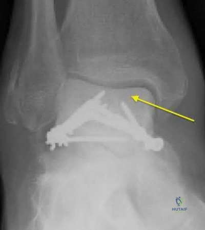 صورة طبية: دليل شامل لكسور وإصابات الجهاز الحركي: رعاية متقدمة في صنعاء مع الأستاذ الدكتور محمد هطيف