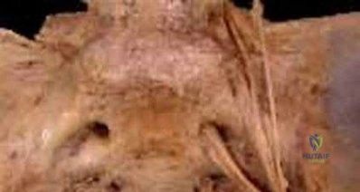صورة طبية: دليل شامل لكسور وإصابات الجهاز الحركي: رعاية متقدمة في صنعاء مع الأستاذ الدكتور محمد هطيف