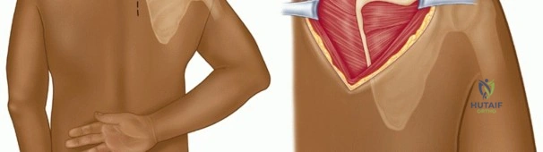 صورة طبية: متلازمة لوح الكتف الطقطقة الأسباب الأعراض والعلاج مع الأستاذ الدكتور محمد هطيف