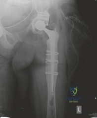 صورة طبية: جراحة مراجعة مفصل الورك المعقدة وزراعة العظام بالضغط: حلول متقدمة لتعويض مفصل الورك الفاشل