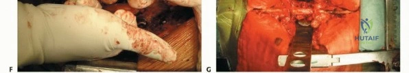 صورة طبية: استئصال الفقرات الكلي بالكتلة الواحدة: نهج شامل لعلاج أورام العمود الفقري مع الأستاذ الدكتور محمد هطيف