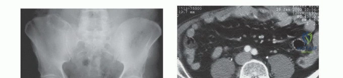 صورة توضيحية لـ جراحة نقائل الحوض: حل شامل لآلام العظام واستعادة الحركة مع الأستاذ الدكتور محمد هطيف