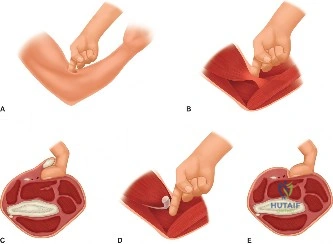 صورة طبية: آلام المرفق المعقدة: فهم وعلاج وتر الكاربوس الزندي القصير وغيرها من إصابات المرفق مع الأستاذ الدكتور محمد هطيف