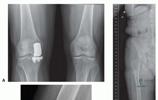 صورة طبية: استبدال مفصل الركبة الجزئي: حل متقدم لآلام الركبة المستمرة مع الأستاذ الدكتور محمد هطيف
