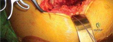 صورة طبية: استبدال مفصل الورك الكلي الناجح في خلل التنسج النمائي للورك: دليل شامل من الأستاذ الدكتور محمد هطيف