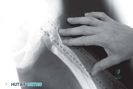 صورة طبية: استبدال مفصل الورك الكلي الناجح في خلل التنسج النمائي للورك: دليل شامل من الأستاذ الدكتور محمد هطيف