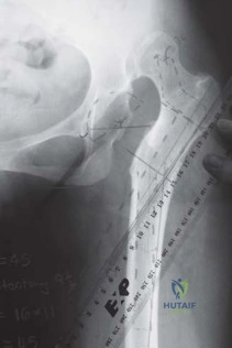 صورة طبية: استبدال مفصل الورك الكلي الناجح في خلل التنسج النمائي للورك: دليل شامل من الأستاذ الدكتور محمد هطيف