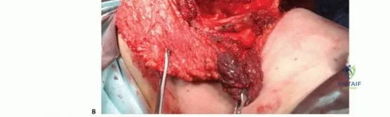 صورة توضيحية لـ بتر الربع الأمامي: كل ما يجب أن تعرفه عن هذا الإجراء المعقد
