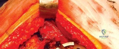 صورة طبية: المدخل الخلفي الجانبي لجراحة استبدال مفصل الورك الكلي: دليل شامل للمرضى في صنعاء مع الأستاذ الدكتور محمد هطيف