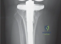 صورة طبية: إتقان موازنة الفجوة في مراجعة استبدال مفصل الركبة: تجنب الأخطاء الشائعة واستعادة الحركة مع الأستاذ الدكتور محمد هطيف